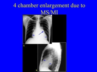 4 chamber enlargement due to MS/MI 