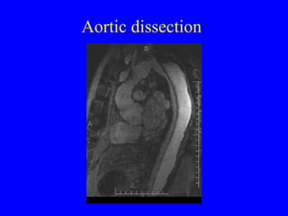 Aortic dissection 