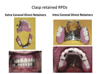 Mc Cracken chapter 2: Consideration for managing Partial tooth Loss | PPTX