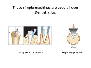 These simple machines are used all over
Dentistry, Eg:
During Extraction of tooth Simple Wedge System
 