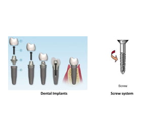 Dental Implants Screw system
 