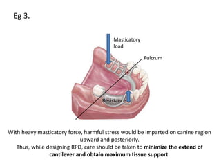 Eg 3.
Masticatory
load
Resistance
Fulcrum
With heavy masticatory force, harmful stress would be imparted on canine region
upward and posteriorly.
Thus, while designing RPD, care should be taken to minimize the extend of
cantilever and obtain maximum tissue support.
 