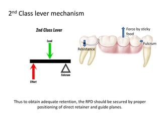 2nd Class lever mechanism
Resistance
Fulcrum
Force by sticky
food
Thus to obtain adequate retention, the RPD should be secured by proper
positioning of direct retainer and guide planes.
 