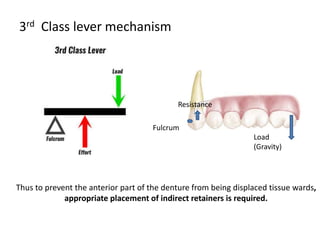 3rd Class lever mechanism
Resistance
Fulcrum
Load
(Gravity)
Thus to prevent the anterior part of the denture from being displaced tissue wards,
appropriate placement of indirect retainers is required.
 