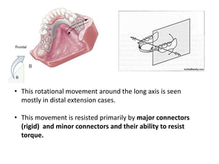 • This rotational movement around the long axis is seen
mostly in distal extension cases.
• This movement is resisted primarily by major connectors
(rigid) and minor connectors and their ability to resist
torque.
 