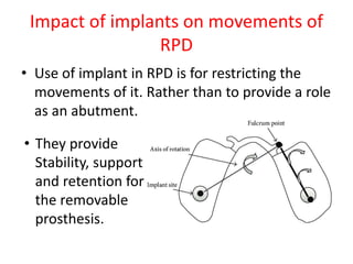 Impact of implants on movements of
RPD
• Use of implant in RPD is for restricting the
movements of it. Rather than to provide a role
as an abutment.
• They provide
Stability, support
and retention for
the removable
prosthesis.
 