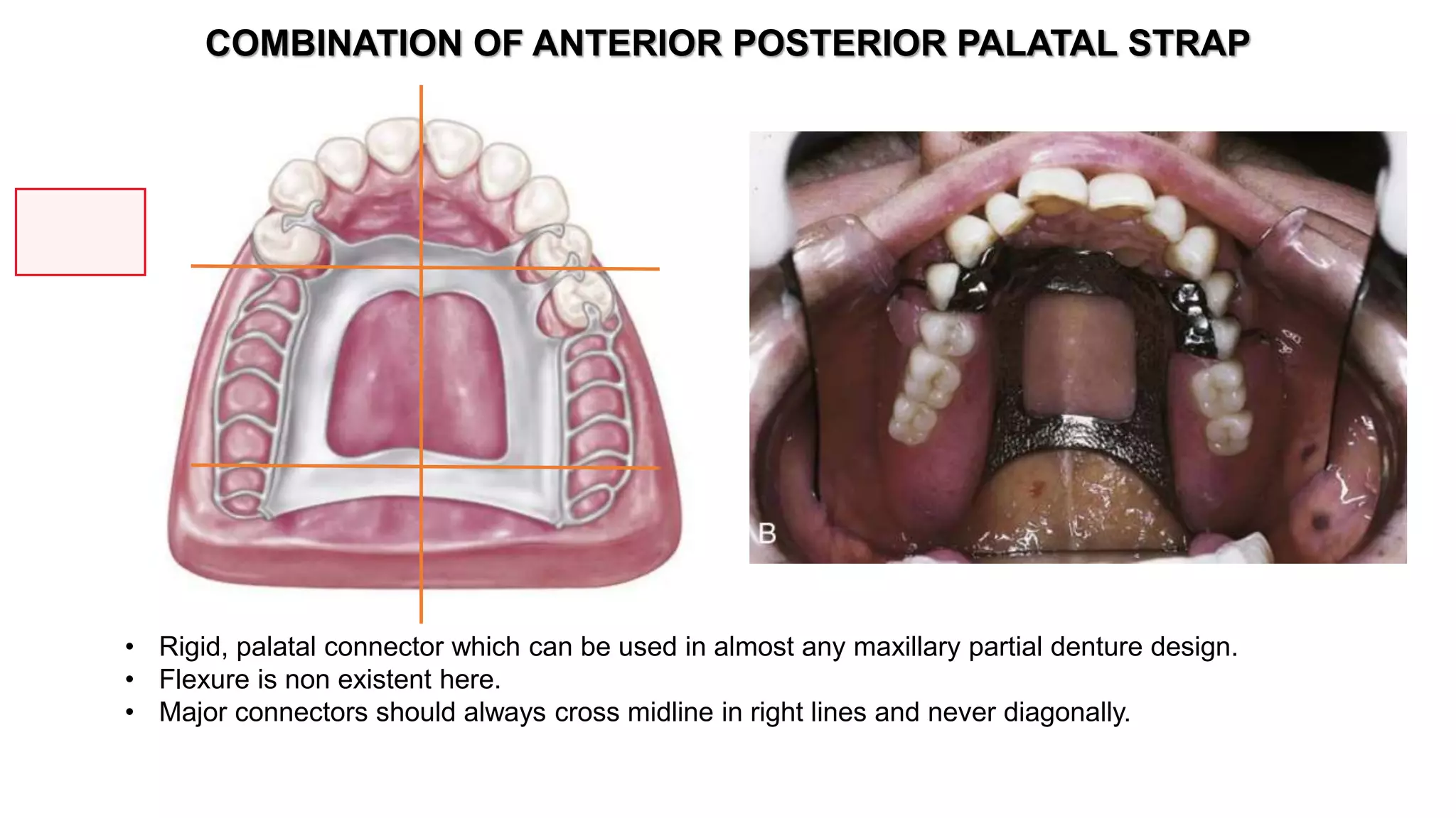 Minor Connector Rpd Design Major and Minor Connectors | PPTX