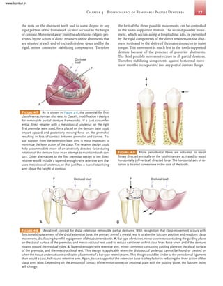 Long Box Rests For Rotational Path Rpd Comprehensive Guide to Removable Partial Prosthodontics: Design ...