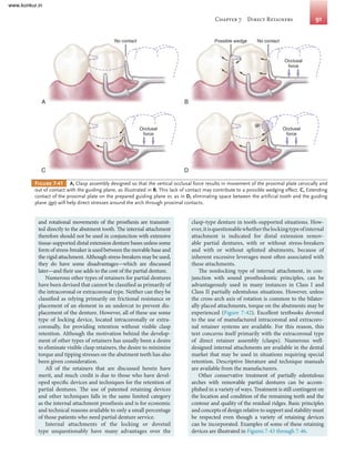 Removable Ridges Comprehensive Guide to Removable Partial Prosthodontics: Design ...