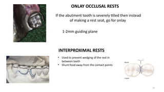 Interproximal Rest Rpd McCracken's Chapter 6 Rest and Rest Seats | PPT