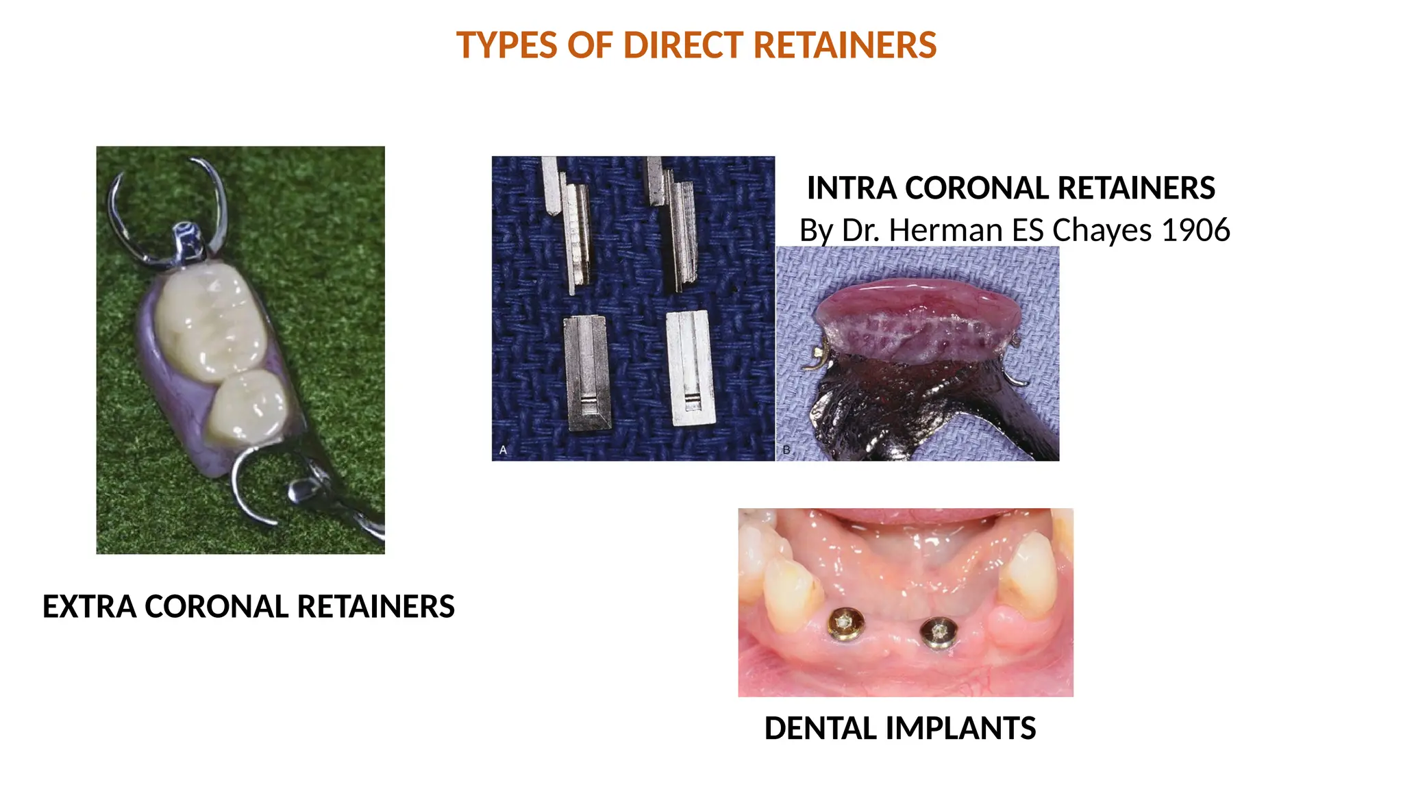TYPES OF DIRECT RETAINERS
INTRA CORONAL RETAINERS
By Dr. Herman ES Chayes 1906
EXTRA CORONAL RETAINERS
DENTAL IMPLANTS
 