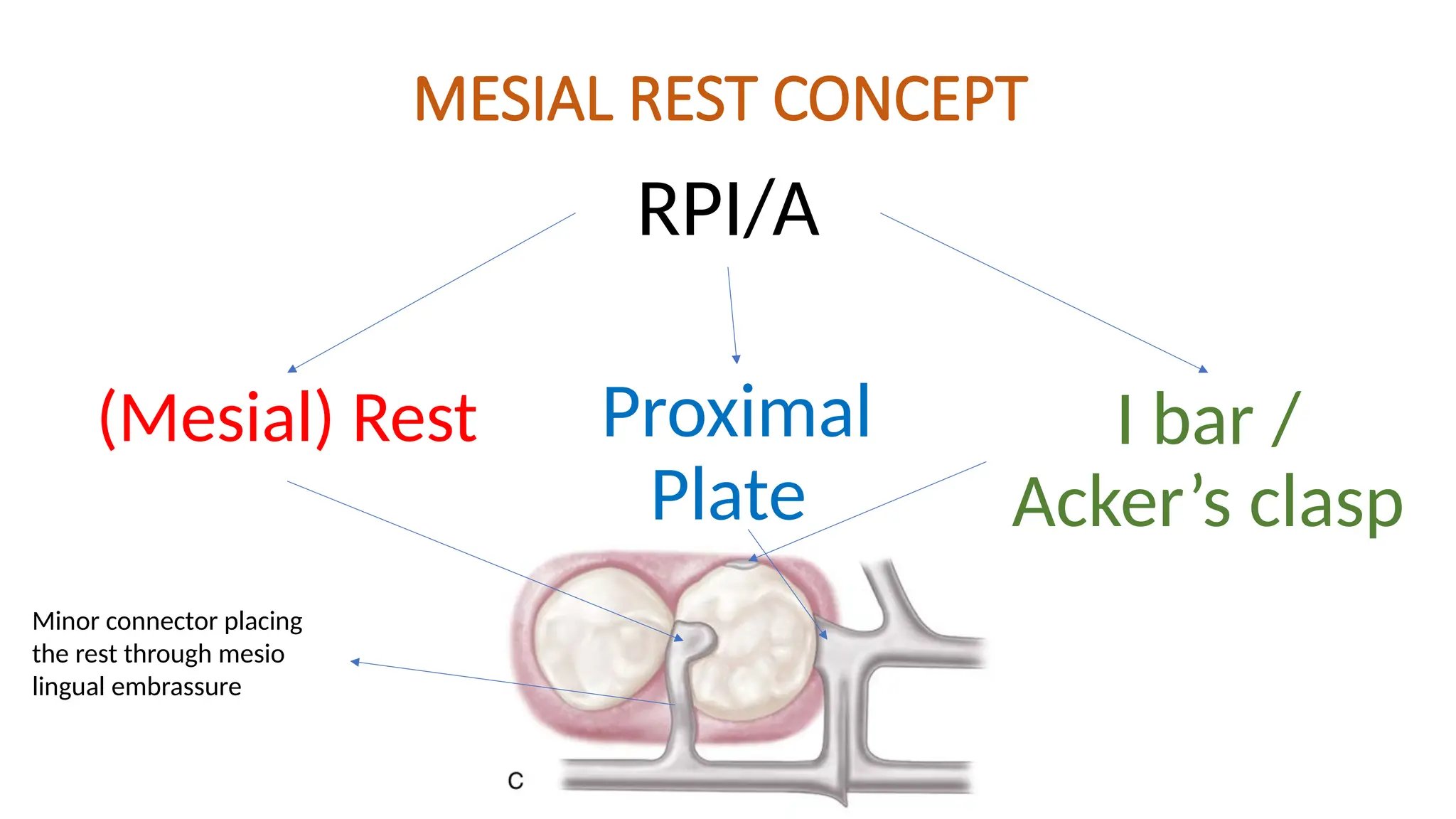 MESIAL REST CONCEPT
RPI/A
(Mesial) Rest Proximal
Plate
I bar /
Acker’s clasp
Minor connector placing
the rest through mesio
lingual embrassure
 