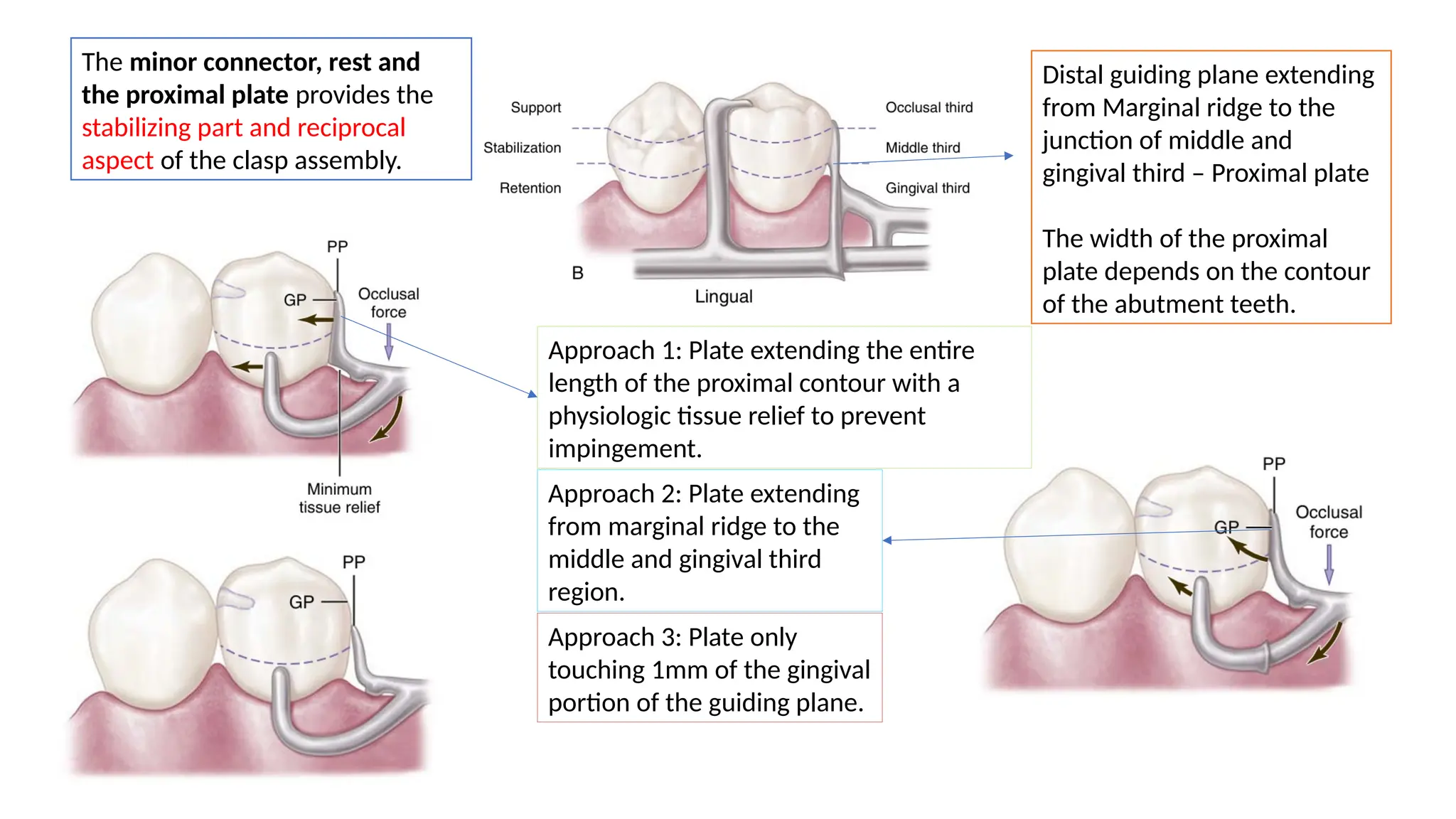 Distal guiding plane extending
from Marginal ridge to the
junction of middle and
gingival third – Proximal plate
The width of the proximal
plate depends on the contour
of the abutment teeth.
The minor connector, rest and
the proximal plate provides the
stabilizing part and reciprocal
aspect of the clasp assembly.
Approach 1: Plate extending the entire
length of the proximal contour with a
physiologic tissue relief to prevent
impingement.
Approach 2: Plate extending
from marginal ridge to the
middle and gingival third
region.
Approach 3: Plate only
touching 1mm of the gingival
portion of the guiding plane.
 