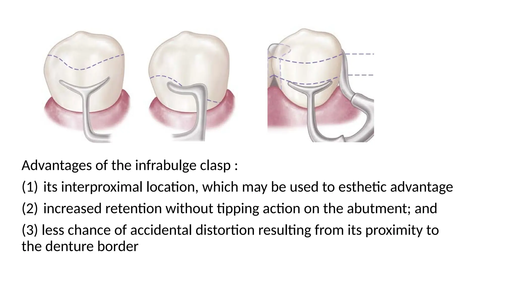 Advantages of the infrabulge clasp :
(1) its interproximal location, which may be used to esthetic advantage
(2) increased retention without tipping action on the abutment; and
(3) less chance of accidental distortion resulting from its proximity to
the denture border
 