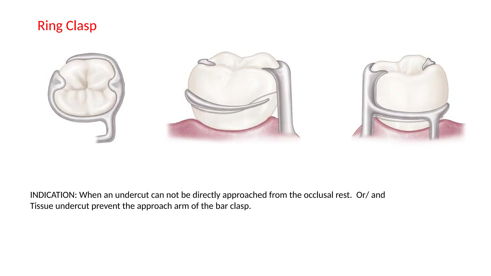 Ring Clasp
INDICATION: When an undercut can not be directly approached from the occlusal rest. Or/ and
Tissue undercut prevent the approach arm of the bar clasp.
 