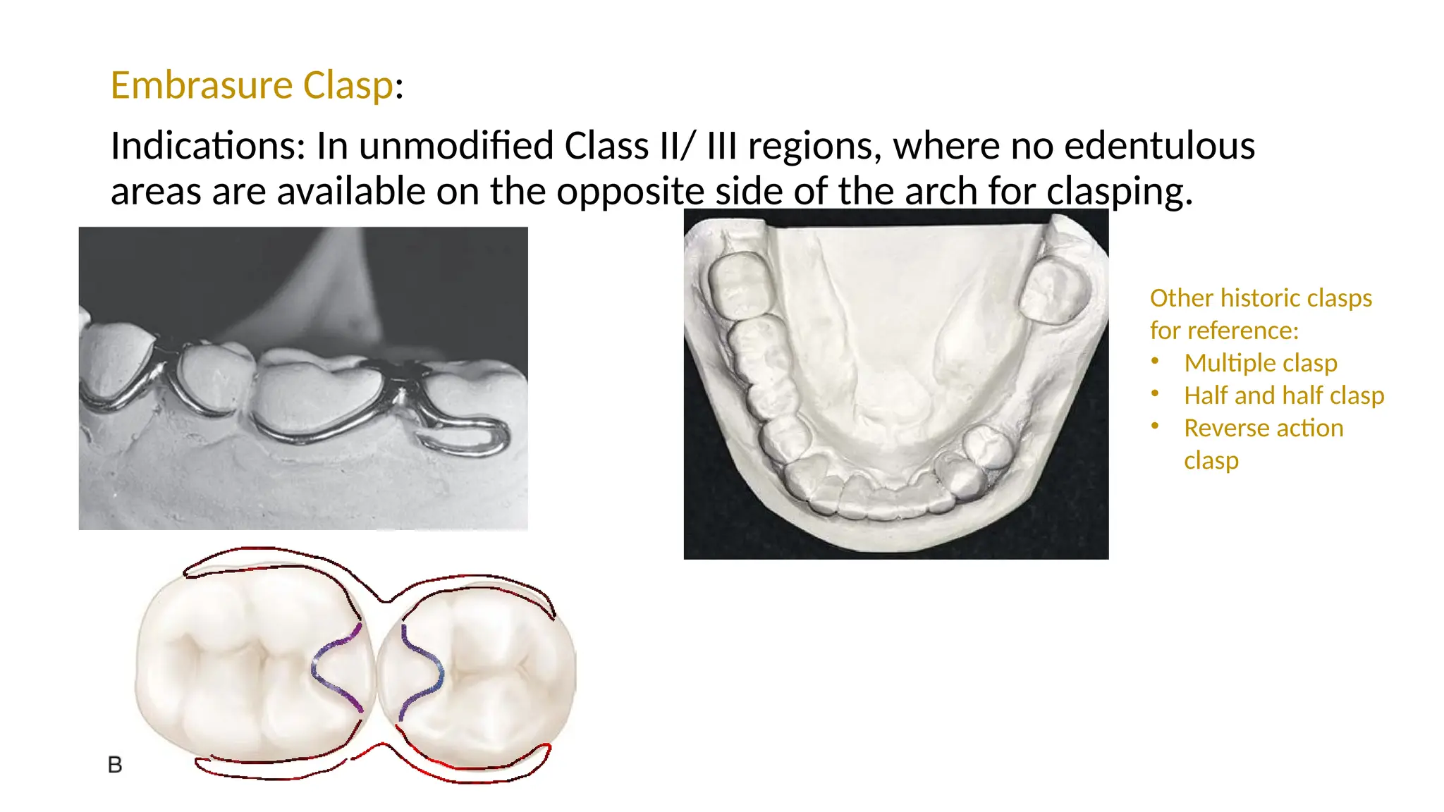 Embrasure Clasp:
Indications: In unmodified Class II/ III regions, where no edentulous
areas are available on the opposite side of the arch for clasping.
Other historic clasps
for reference:
• Multiple clasp
• Half and half clasp
• Reverse action
clasp
 