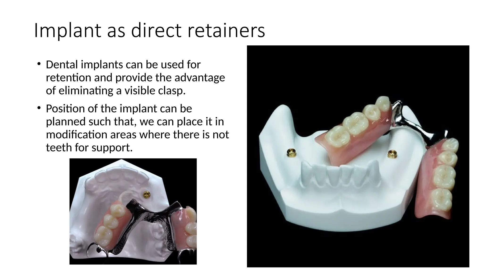 Implant as direct retainers
• Dental implants can be used for
retention and provide the advantage
of eliminating a visible clasp.
• Position of the implant can be
planned such that, we can place it in
modification areas where there is not
teeth for support.
 