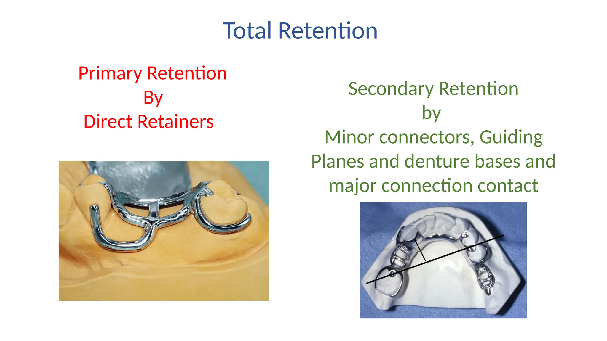 Total Retention
Primary Retention
By
Direct Retainers
Secondary Retention
by
Minor connectors, Guiding
Planes and denture bases and
major connection contact
with tissues
 