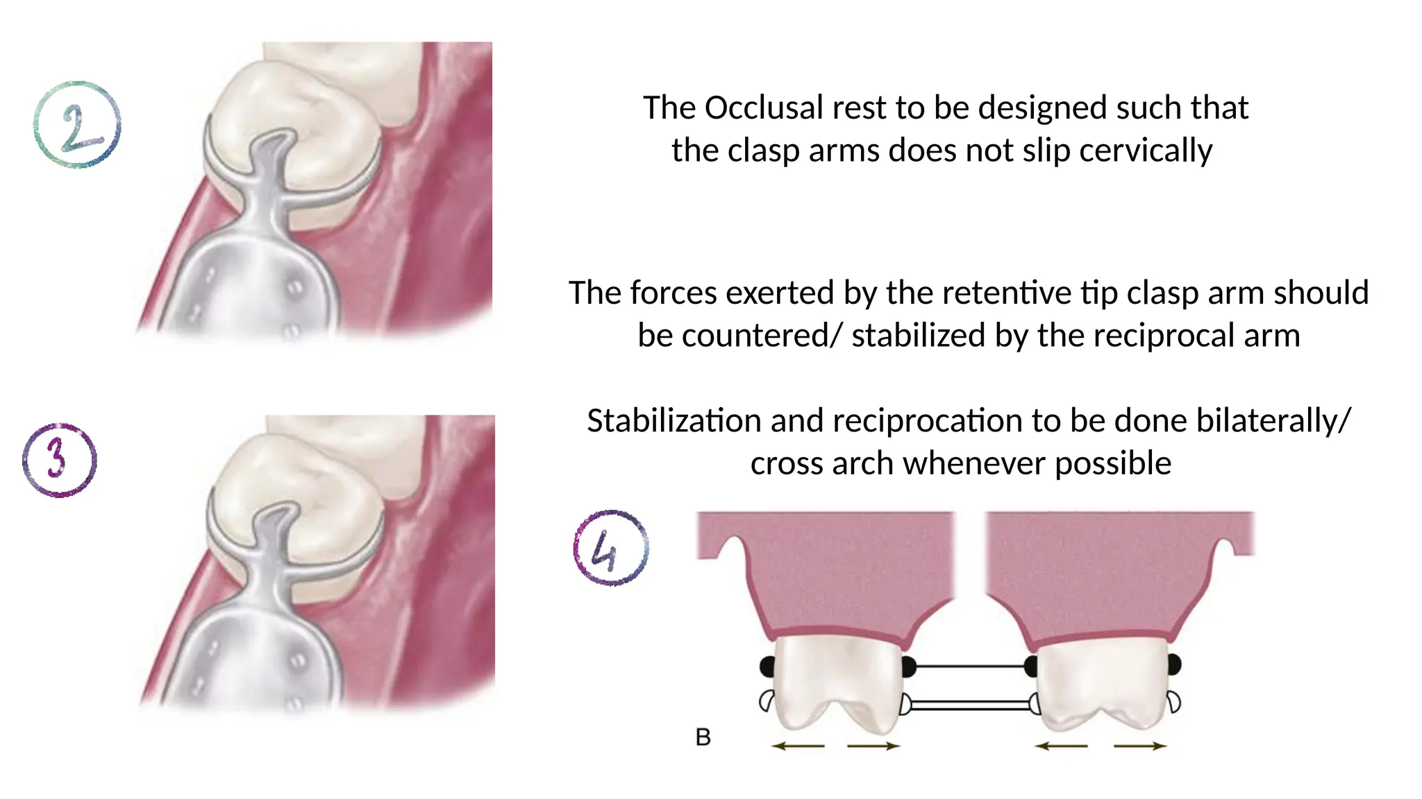 The Occlusal rest to be designed such that
the clasp arms does not slip cervically
The forces exerted by the retentive tip clasp arm should
be countered/ stabilized by the reciprocal arm
Stabilization and reciprocation to be done bilaterally/
cross arch whenever possible
 