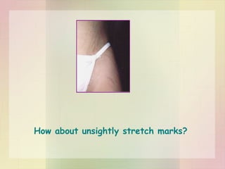 How about unsightly stretch marks? 