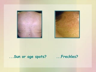...Sun or age spots?  ...Freckles? 
