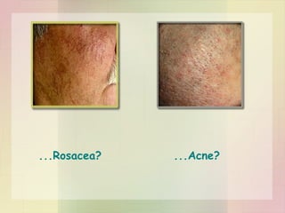 ...Rosacea?  ...Acne? 