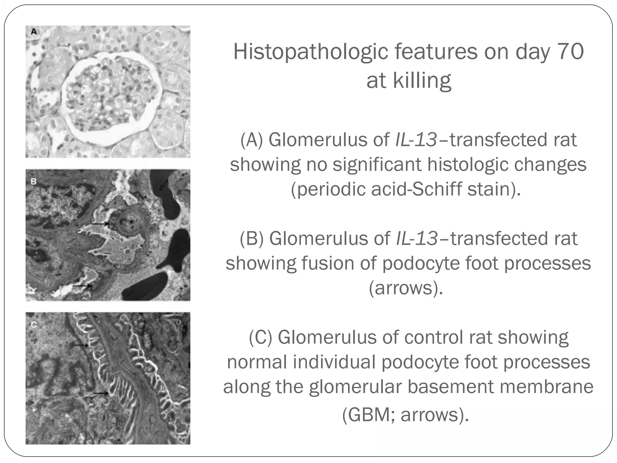 Histopathologic features on day 70
              at killing

 (A) Glomerulus of IL-13–transfected rat
showing no significant histologic changes
       (periodic acid-Schiff stain).

 (B) Glomerulus of IL-13–transfected rat
showing fusion of podocyte foot processes
                (arrows).

   (C) Glomerulus of control rat showing
normal individual podocyte foot processes
along the glomerular basement membrane
             (GBM; arrows).
 