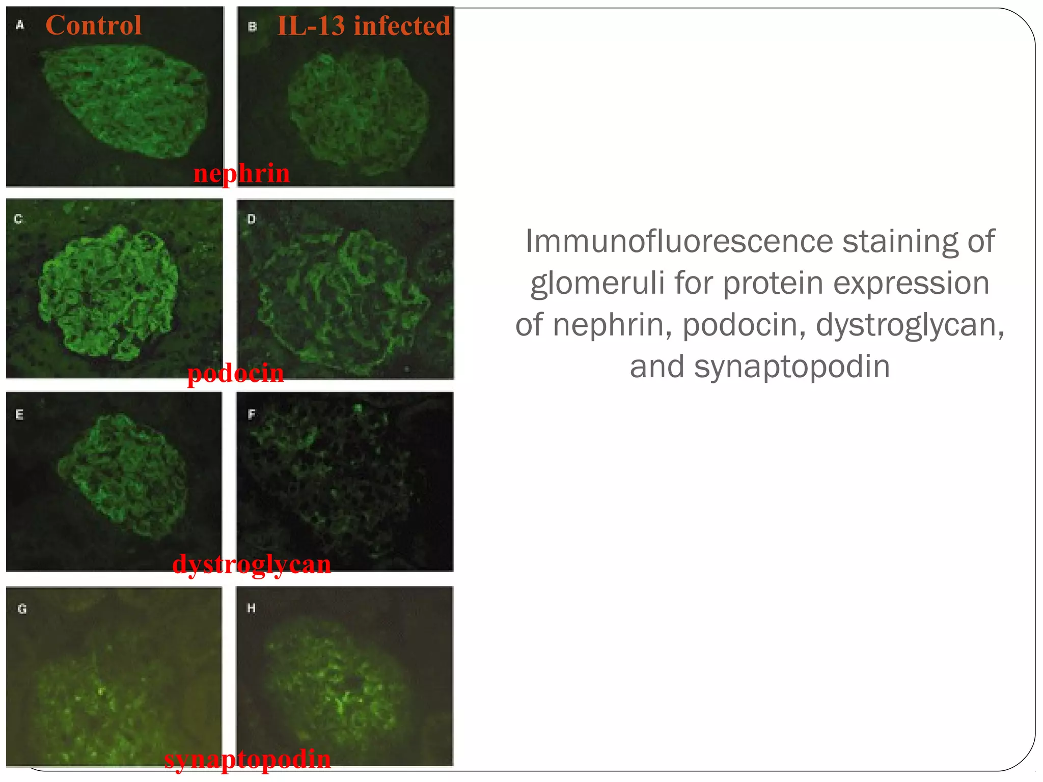 Control           IL-13 infected




            nephrin

                                    Immunofluorescence staining of
                                     glomeruli for protein expression
                                   of nephrin, podocin, dystroglycan,
           podocin                         and synaptopodin




          dystroglycan




          synaptopodin
 