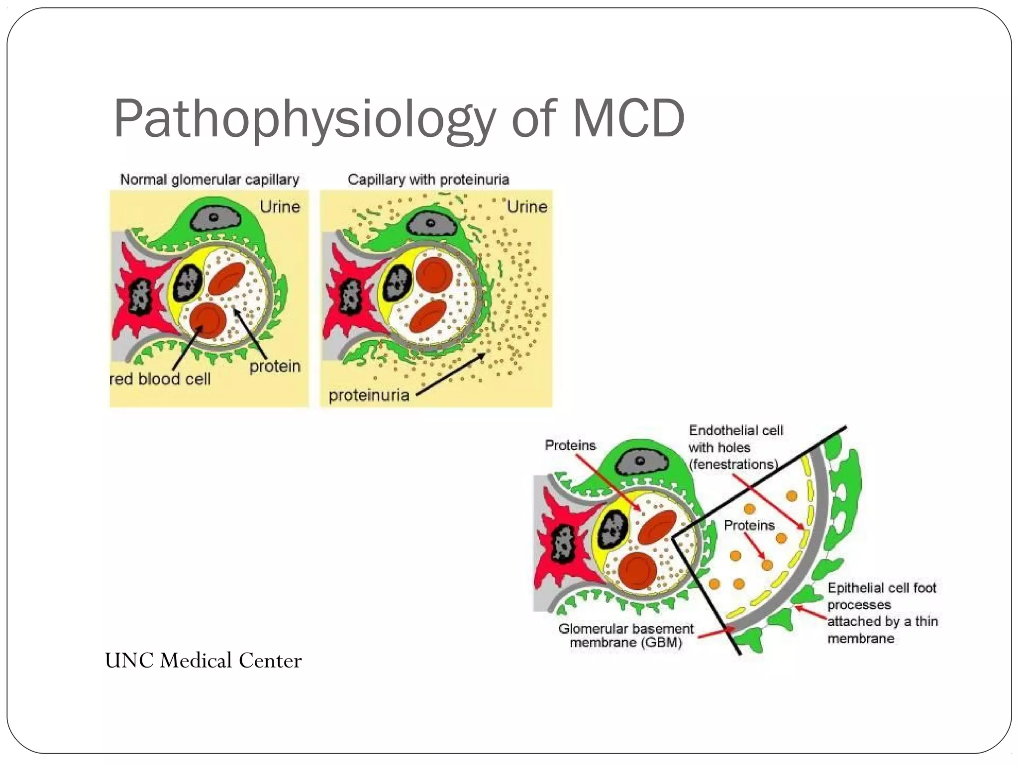 Pathophysiology of MCD
UNC




UNC Medical Center
 