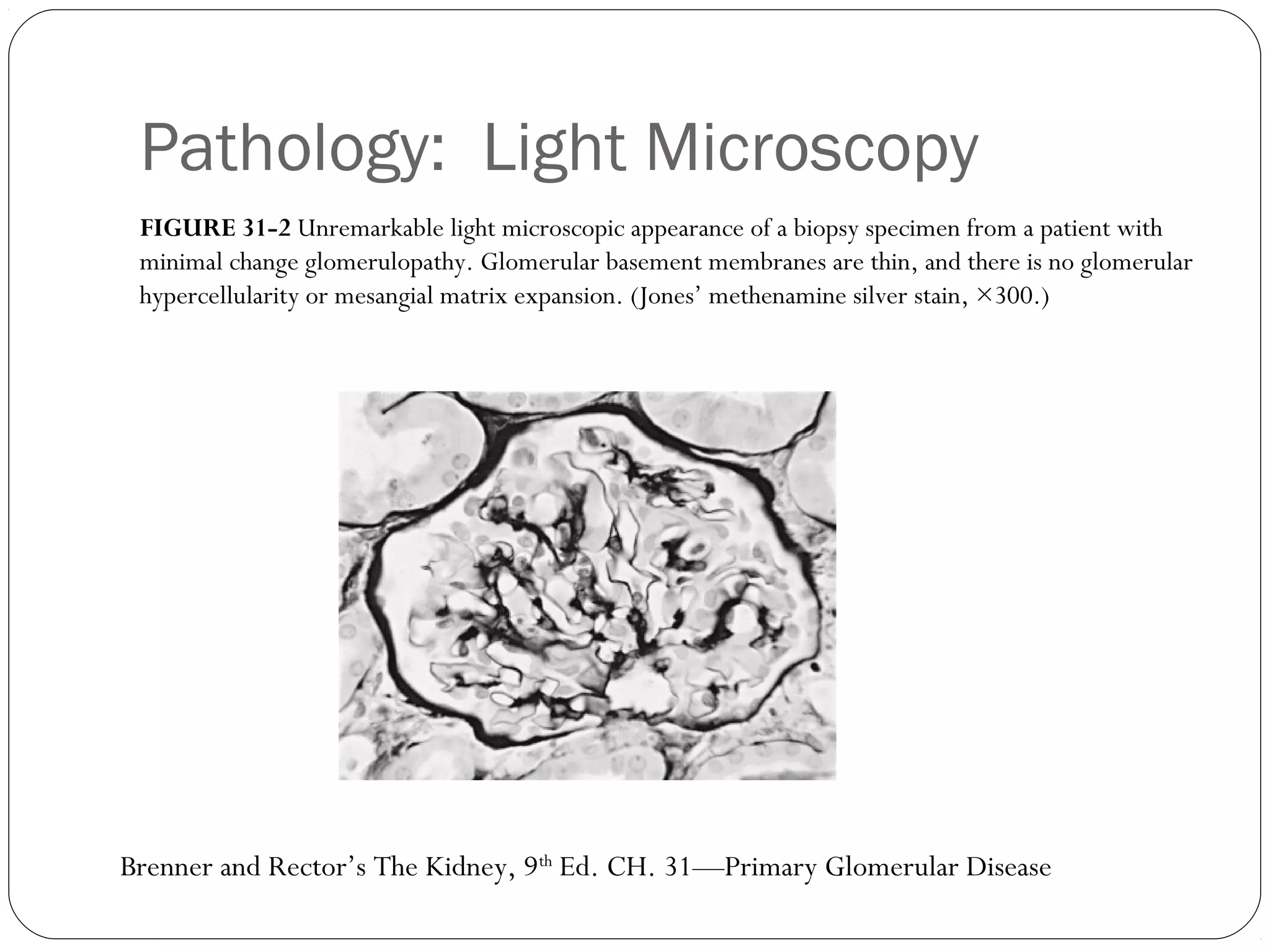Pathology: Light Microscopy
 FIGURE 31-2 Unremarkable light microscopic appearance of a biopsy specimen from a patient with
 minimal change glomerulopathy. Glomerular basement membranes are thin, and there is no glomerular
 hypercellularity or mesangial matrix expansion. (Jones’ methenamine silver stain, ×300.)




Brenner and Rector’s The Kidney, 9th Ed. CH. 31—Primary Glomerular Disease
 
