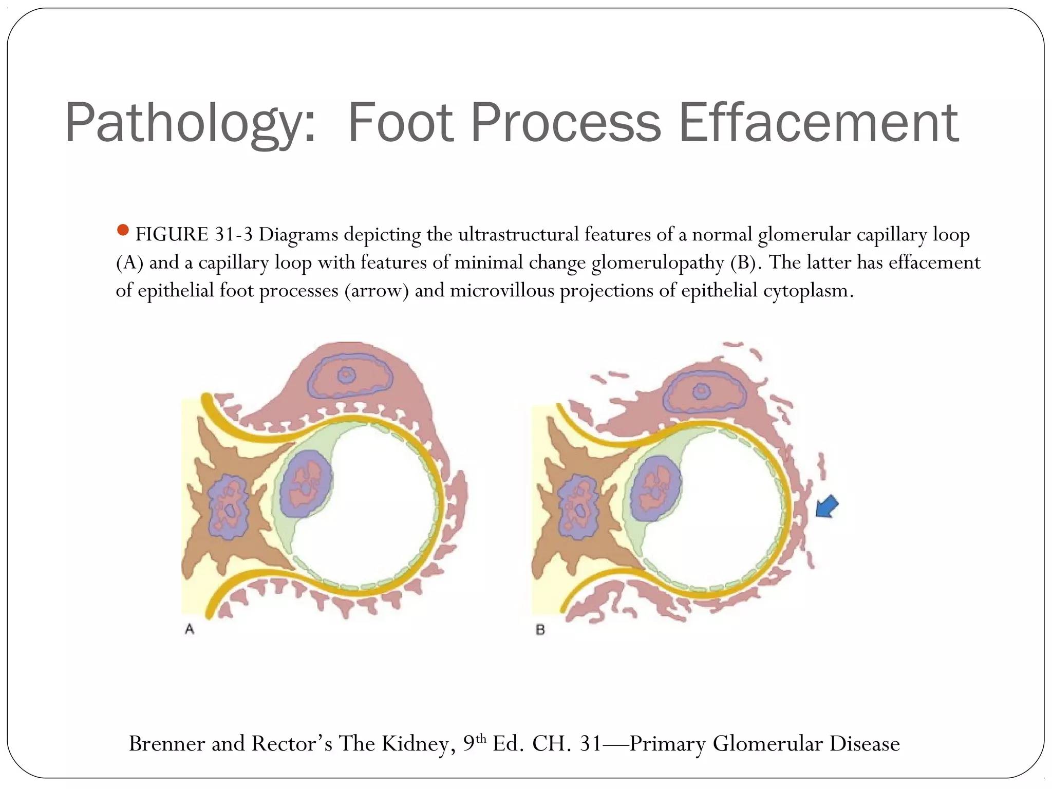 Pathology: Foot Process Effacement
 FIGURE 31-3 Diagrams depicting the ultrastructural features of a normal glomerular capillary loop
 (A) and a capillary loop with features of minimal change glomerulopathy (B). The latter has effacement
 of epithelial foot processes (arrow) and microvillous projections of epithelial cytoplasm.




  Brenner and Rector’s The Kidney, 9th Ed. CH. 31—Primary Glomerular Disease
 