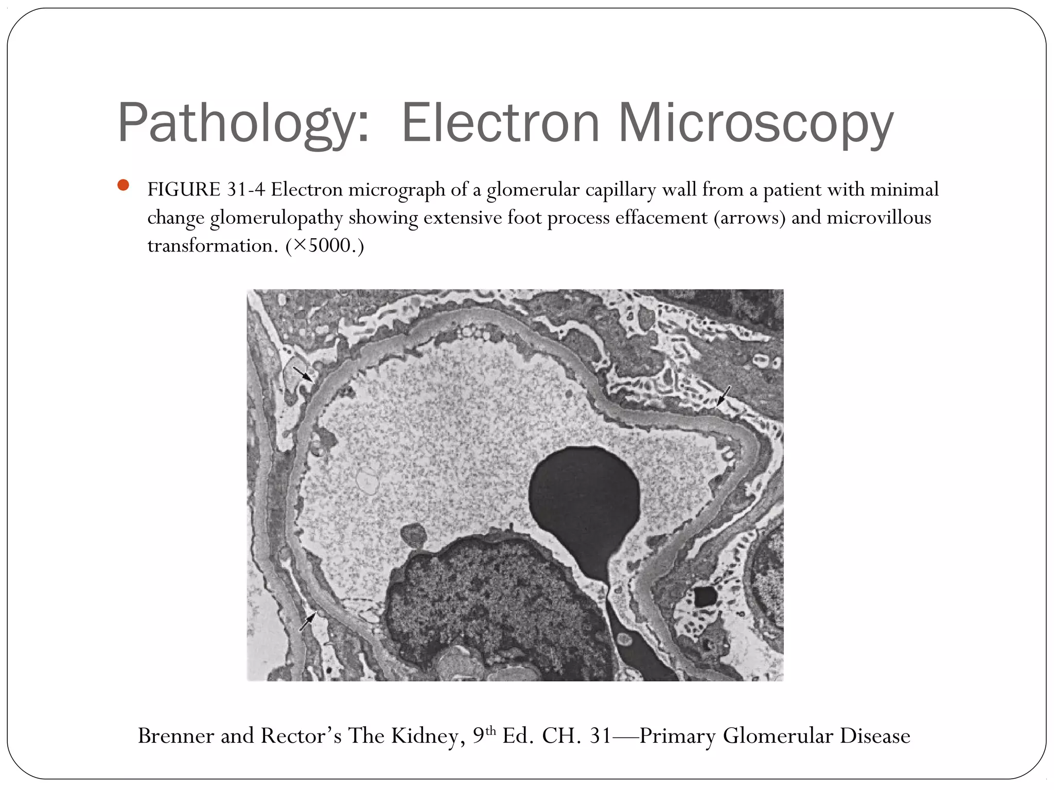 Pathology: Electron Microscopy
 FIGURE 31-4 Electron micrograph of a glomerular capillary wall from a patient with minimal
   change glomerulopathy showing extensive foot process effacement (arrows) and microvillous
   transformation. (×5000.)




  Brenner and Rector’s The Kidney, 9th Ed. CH. 31—Primary Glomerular Disease
 