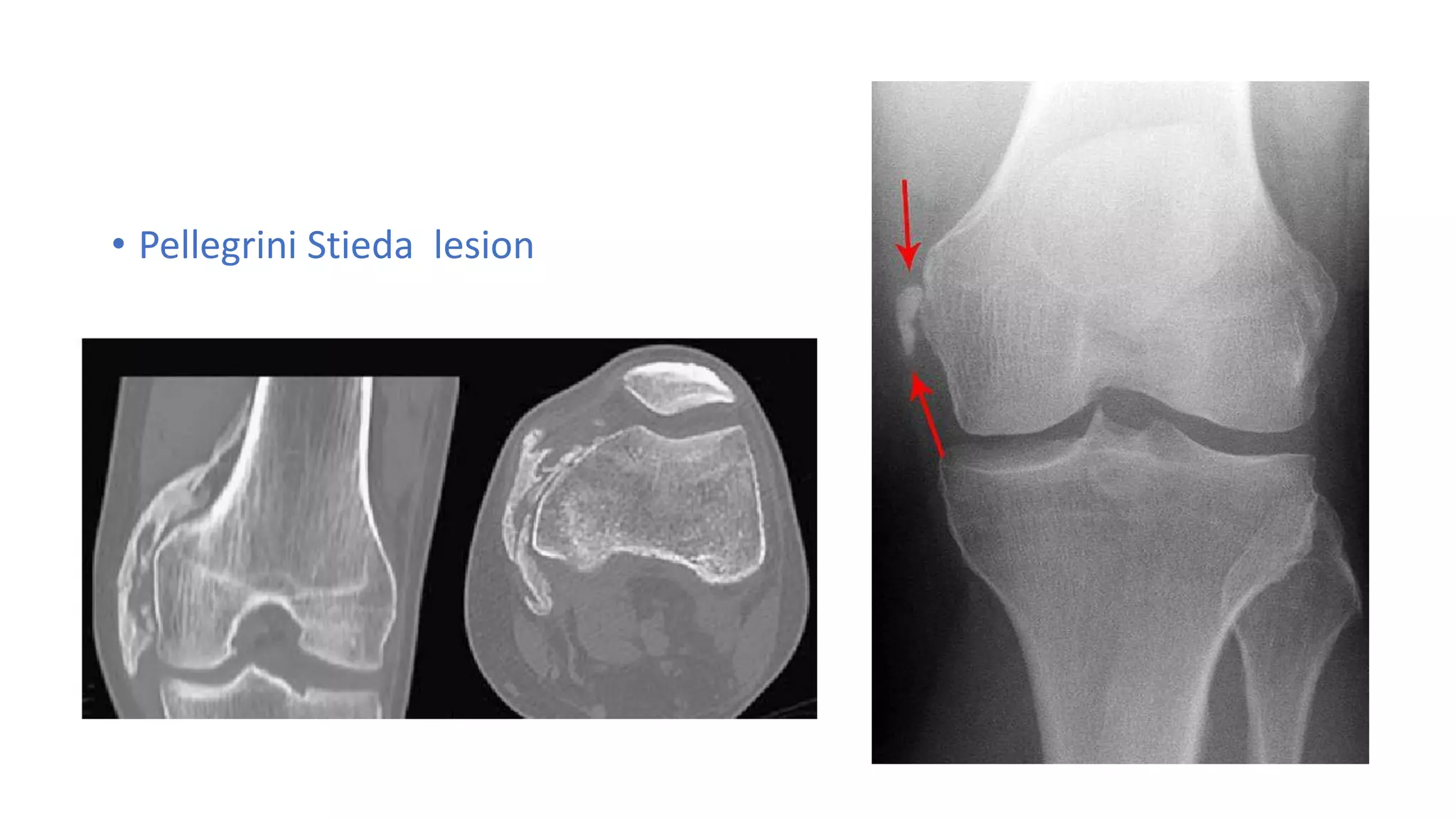 MCL,LCL & ALL injuries of the knee | PDF