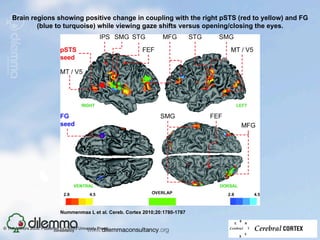 Brain regions showing positive change in coupling with the right pSTS (red to yellow) and FG
            (blue to turquoise) while viewing gaze shifts versus opening/closing the eyes.




                              Nummenmaa L et al. Cereb. Cortex 2010;20:1780-1787


© The Authors 2009. Published by Oxford University Press.
 