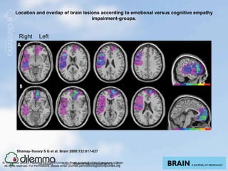 Location and overlap of brain lesions according to emotional versus cognitive empathy
                                            impairment-groups.


            Right           Left




           Shamay-Tsoory S G et al. Brain 2009;132:617-627


© The Author (2008). Published by Oxford University Press on behalf of the Guarantors of Brain.
 All rights reserved. For Permissions, please email: journals.permissions@oxfordjournals.org
 