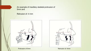 An example of maxillary skeletal protrusion of
5mm and
Retrusion of -4 mm
Protrusion of 5mm Retrusion of -4mm
 