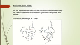 Mandibular plane angle :
It is the angle between frankfort horizontal and the line drawn along
the lower border of the mandible through constructed gonion and
menton.
Mandibular plane angle is 22º ±4º
 
