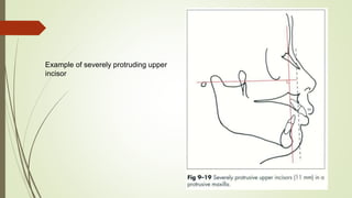 Example of severely protruding upper
incisor
 