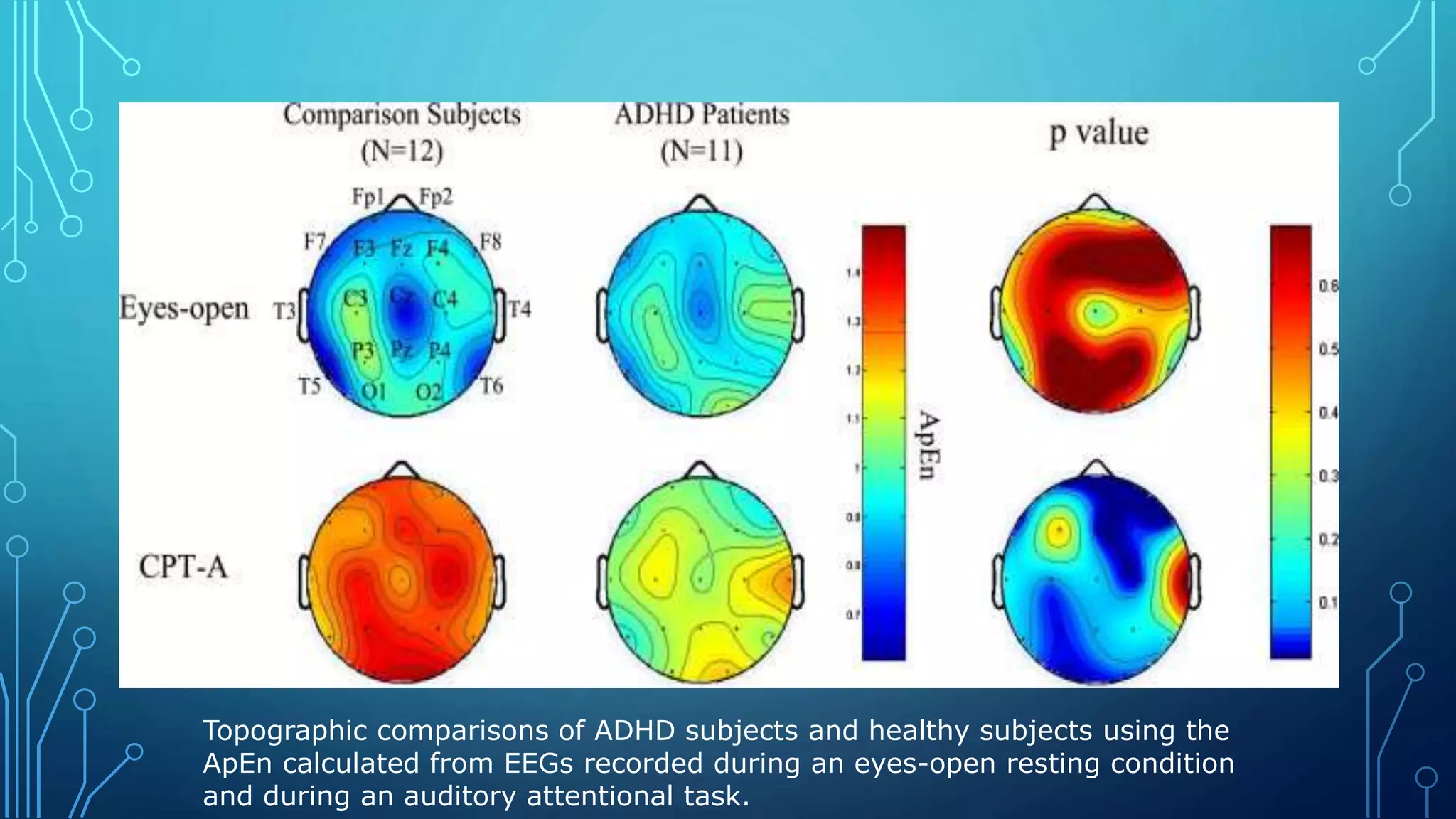 Topographic comparisons of ADHD subjects and healthy subjects using the
ApEn calculated from EEGs recorded during an eyes-open resting condition
and during an auditory attentional task.
 