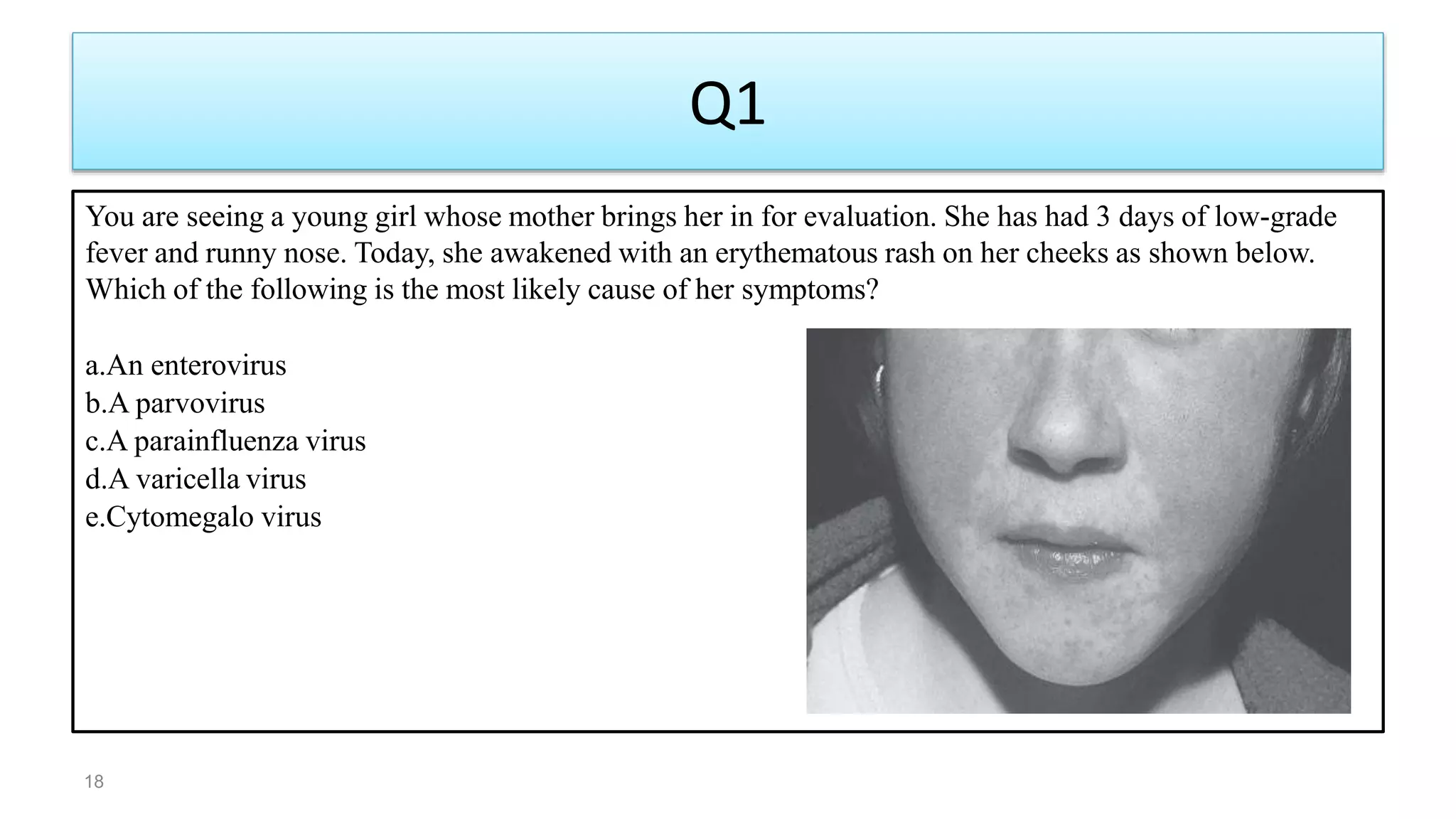Q1
You are seeing a young girl whose mother brings her in for evaluation. She has had 3 days of low-grade
fever and runny nose. Today, she awakened with an erythematous rash on her cheeks as shown below.
Which of the following is the most likely cause of her symptoms?
a.An enterovirus
b.A parvovirus
c.A parainfluenza virus
d.A varicella virus
e.Cytomegalo virus
18
 