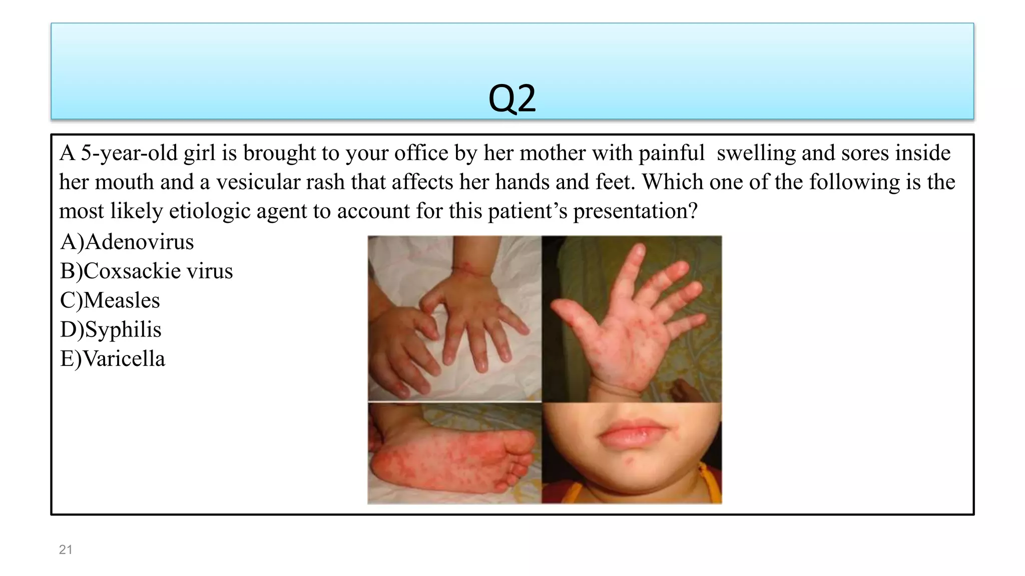 A 5-year-old girl is brought to your office by her mother with painful swelling and sores inside
her mouth and a vesicular rash that affects her hands and feet. Which one of the following is the
most likely etiologic agent to account for this patient’s presentation?
A)Adenovirus
B)Coxsackie virus
C)Measles
D)Syphilis
E)Varicella
Q2
21
 