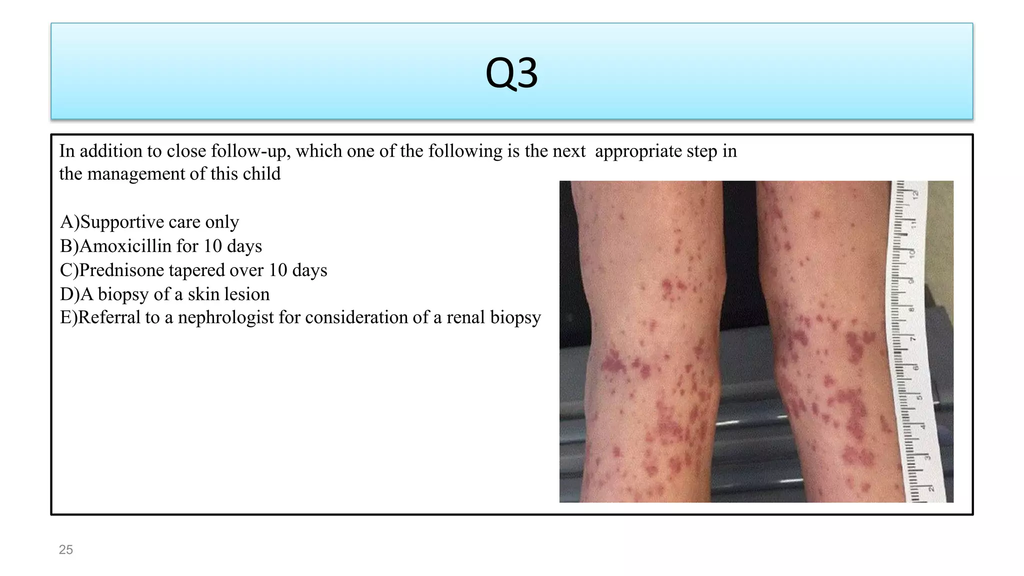 Q3
In addition to close follow-up, which one of the following is the next appropriate step in
the management of this child
A)Supportive care only
B)Amoxicillin for 10 days
C)Prednisone tapered over 10 days
D)A biopsy of a skin lesion
E)Referral to a nephrologist for consideration of a renal biopsy
25
 