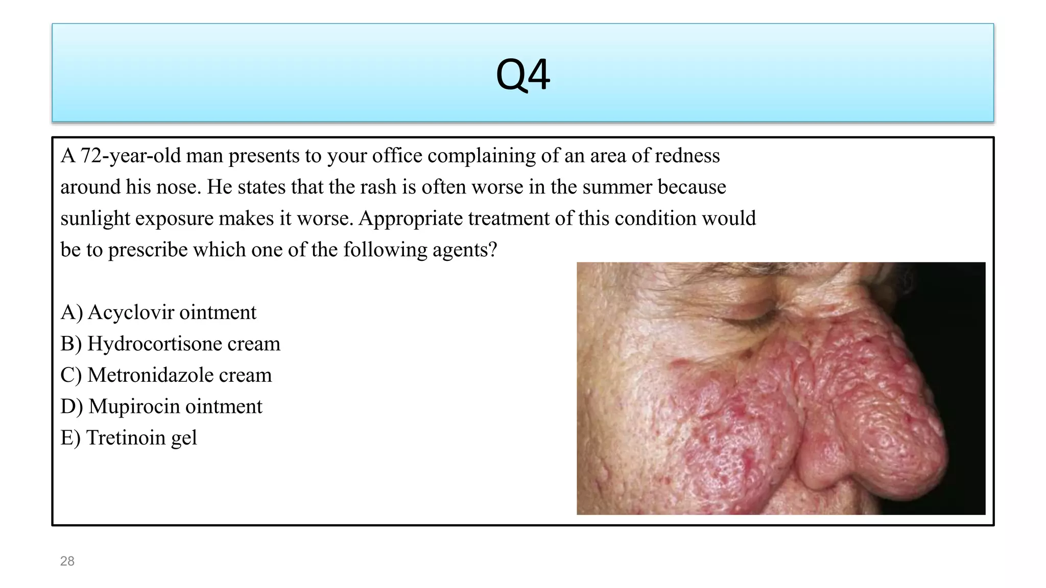 Q4
A 72-year-old man presents to your office complaining of an area of redness
around his nose. He states that the rash is often worse in the summer because
sunlight exposure makes it worse. Appropriate treatment of this condition would
be to prescribe which one of the following agents?
A) Acyclovir ointment
B) Hydrocortisone cream
C) Metronidazole cream
D) Mupirocin ointment
E) Tretinoin gel
28
 