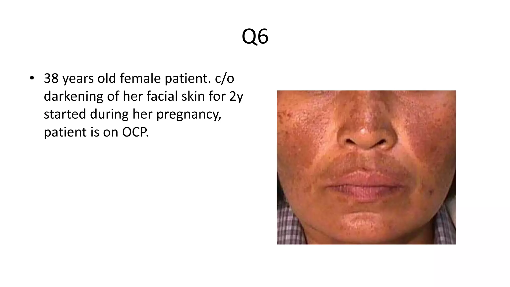 Q6
• 38 years old female patient. c/o
darkening of her facial skin for 2y
started during her pregnancy,
patient is on OCP.
 