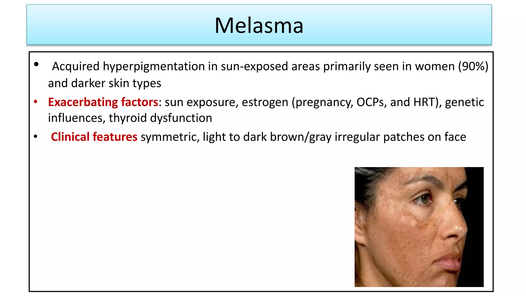 Melasma
• Acquired hyperpigmentation in sun-exposed areas primarily seen in women (90%)
and darker skin types
• Exacerbating factors: sun exposure, estrogen (pregnancy, OCPs, and HRT), genetic
influences, thyroid dysfunction
• Clinical features symmetric, light to dark brown/gray irregular patches on face
 