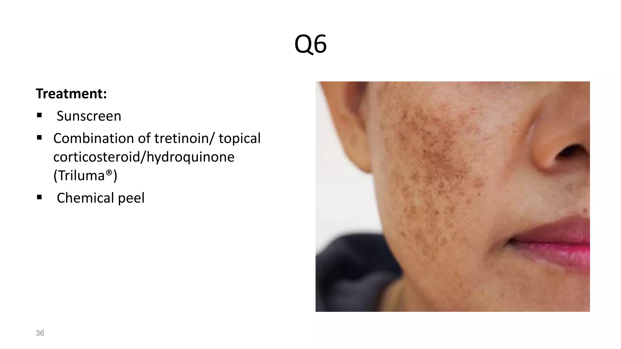 Q6
Treatment:
 Sunscreen
 Combination of tretinoin/ topical
corticosteroid/hydroquinone
(Triluma®)
 Chemical peel
36
 