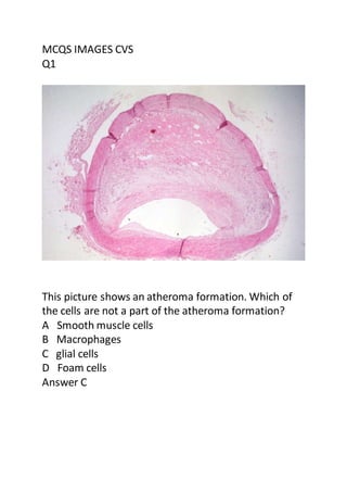MCQS IMAGES CVS
Q1
This picture shows an atheroma formation. Which of
the cells are not a part of the atheroma formation?
A Smooth muscle cells
B Macrophages
C glial cells
D Foam cells
Answer C
 
