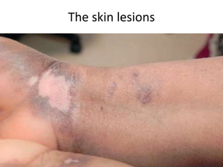 The skin lesions
 