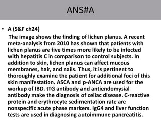 ANS#A
• A (S&F ch24)
The image shows the finding of lichen planus. A recent
meta-analysis from 2010 has shown that patients with
lichen planus are five times more likely to be infected
with hepatitis C in comparison to control subjects. In
addition to skin, lichen planus can affect mucous
membranes, hair, and nails. Thus, it is pertinent to
thoroughly examine the patient for additional foci of this
skin manifestation. ASCA and p-ANCA are used for the
workup of IBD. tTG antibody and antiendomysial
antibody make the diagnosis of celiac disease. C-reactive
protein and erythrocyte sedimentation rate are
nonspecific acute phase markers. IgG4 and liver function
tests are used in diagnosing autoimmune pancreatitis.
 