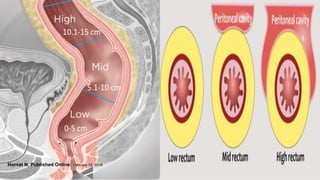 Figure 6a. Tumor location in the craniocaudal direction. (a) Illustration depicts the sagittal view of the rectum and provides the measurements of the tumor from the anal
verge, which help categorize tumor location. Blue lines separate the low, mid-, and high rectum. (Figure 6a reprinted, under a CC BY-ND 4.0 license, from Memorial Sloan
Kettering Cancer Center.) (b–d) Sagittal T2-weighted MR images show tumors (arrow) in the high (b), mid- (c), and low (d) rectum. Dotted line = measurement from the
rectum entrance to the tumor location.
Horvat N. Published Online: February 15, 2019
 
